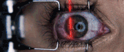 Lasereye
