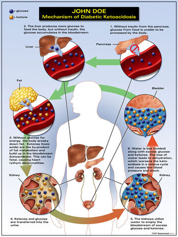 Arquivo:Symptoms-Of-Diabetes-Ketoacidosis-2.jpg