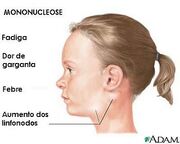 Mononucleose-788542.jpg
