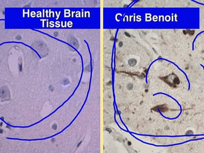 File:Benoit brain.jpg