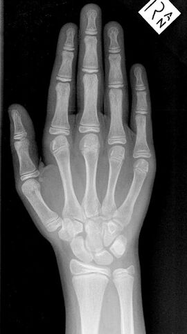 File:Handxray.jpg
