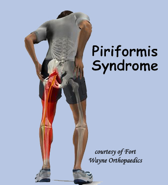 Piriformis Syndrome Ref Pain Distribution