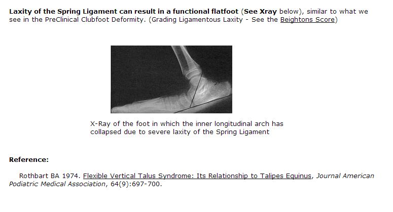 Spring Ligament Laxity Xray of Foot