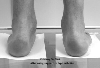 Post Arch Support