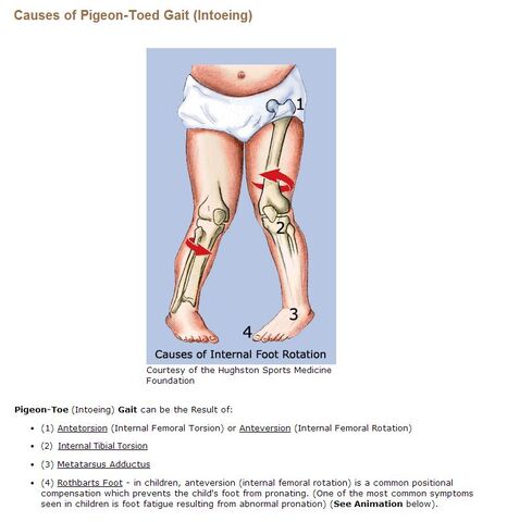 File:Causes of Intoeing Intro.jpg
