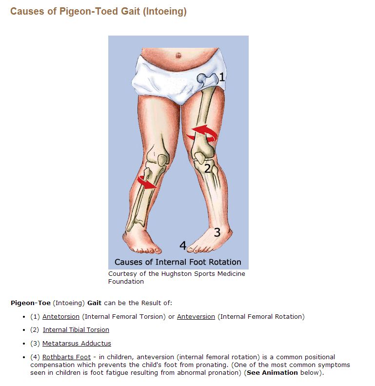 Causes of Intoeing Intro