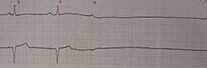 230px-Asystole11