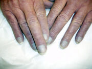 Upper cyanosis3