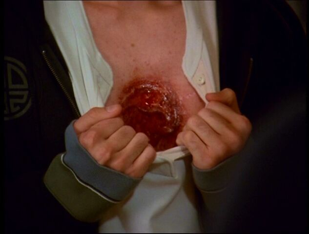File:Chris' wound.jpg