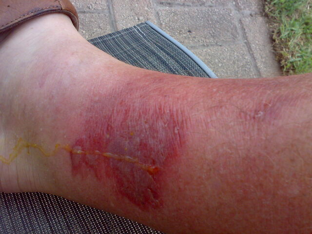 File:Bite-at-1-week.jpg