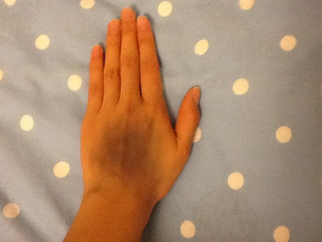 File:Grossbruise.jpg