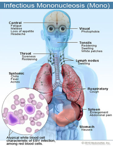 File:2011-infectious-mononucleosis.jpg
