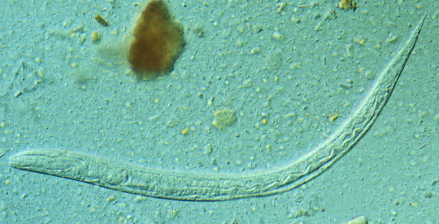 Archivo:Estrongiloidiasis.jpg