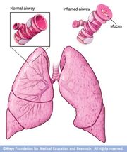 Asthma
