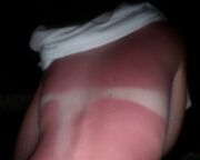 Sunburnt woman