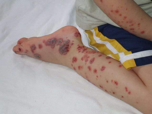 File:Purpura2.jpg