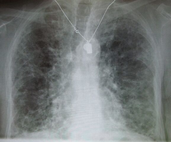 File:IPF amiodarone.jpg