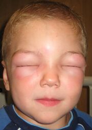 Angioedema2010