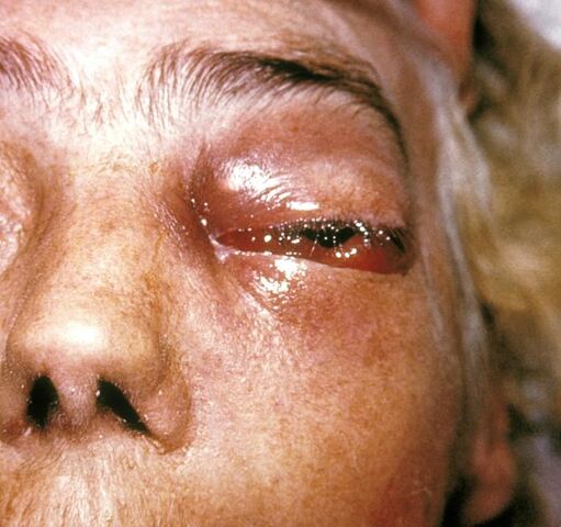 File:Periorbital fungal infection.jpg