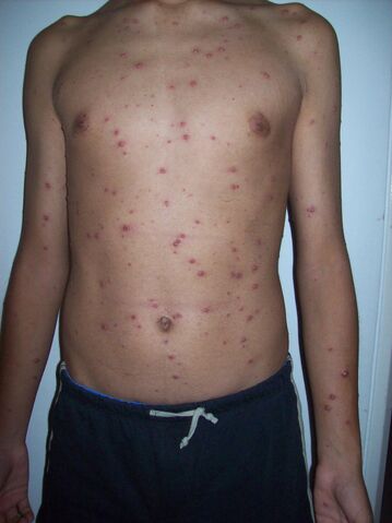 File:Varicela Aranzales.jpg