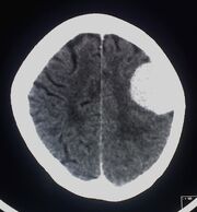 Contrast enhanced meningioma