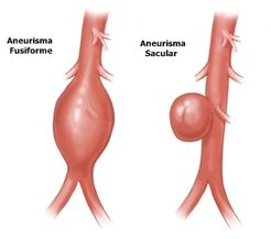 Aneurisma2.jpg