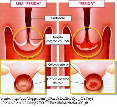 Arquivo:Figura5 HPV.jpg
