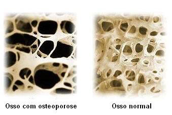 Osteoporose1.jpg