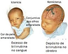 Encefalopatia.jpg