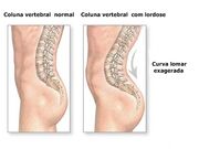DesviosColuna3.jpg