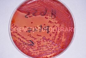 Tuberculose4.jpg