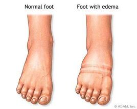 Ins edema