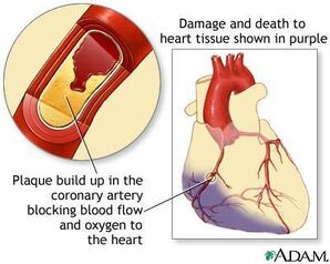 Infarto