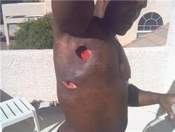 Kevin Randleman staph infection