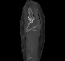 Mummy-upper-limbs
