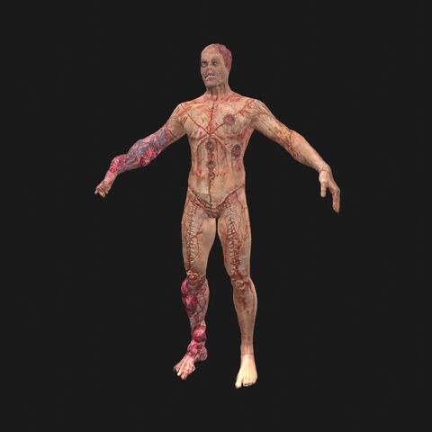 File:Patient14 perspFront.jpeg