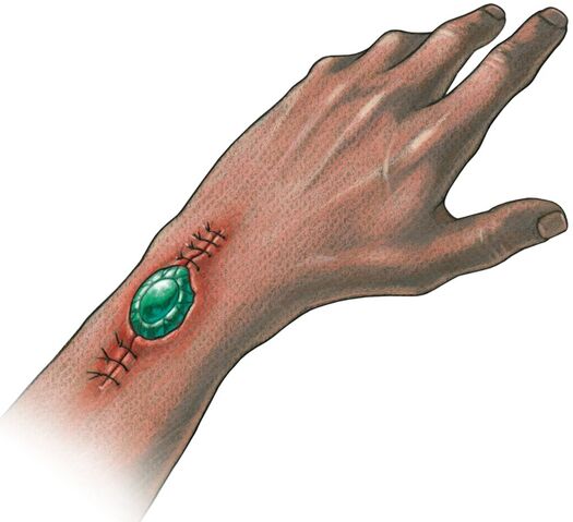 File:Implanted ioun stone.jpg