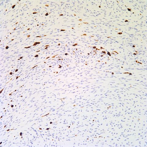 File:Melan-A.pigmented neurofibroma.2.jpg