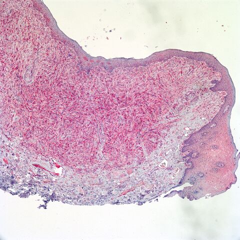 File:Factor XIIIa.13a.dermatofibroma.fibrous histiocytoma.jpg