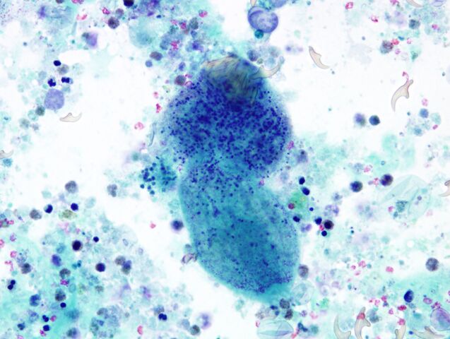 File:Hydatid Cyst8.jpg