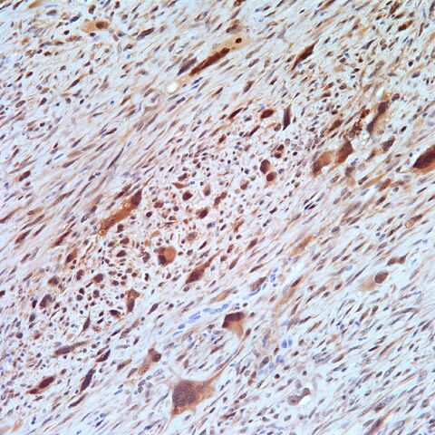 File:CDK4.dedifferentiated liposarcoma.DDL.2.jpg