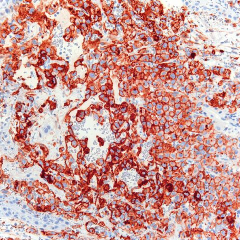 File:CD10.epithelioid angiosarcoma.2.jpg