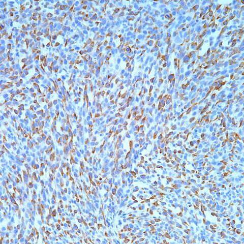 File:HMWCK.Cytokeratin 903.sarcomatoid carcinoma.200x.jpg