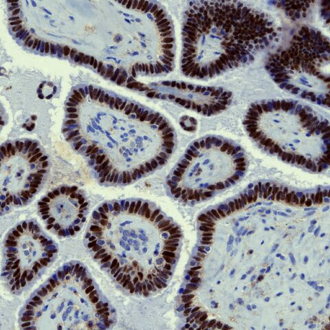 File:Ovary Serous LMP-Pax8 positive.jpg