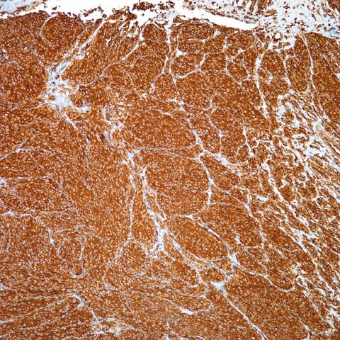 File:Vimentin.cellular blue nevus.jpg