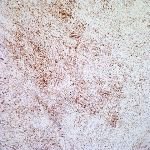 File:Desmin.mammary myofibroblastoma.1.jpg