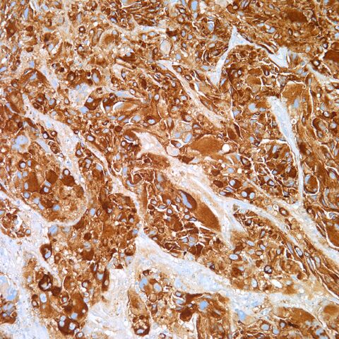 File:HMB-45.melanoma.3.jpg