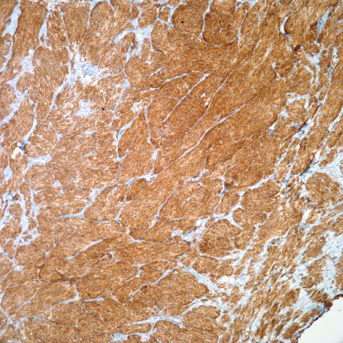 File:Bcl-2.cellular blue nevus.jpg