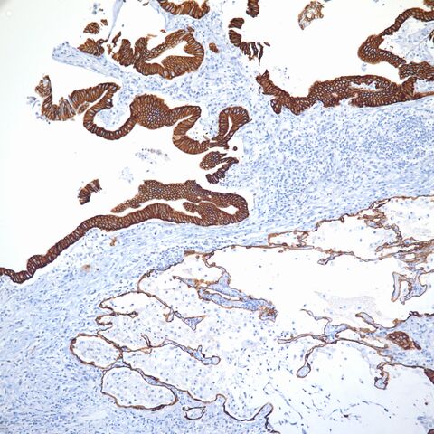 File:CK7.lung with lambertosis.1.jpg
