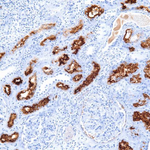 File:RCC marker.kidney.jpg